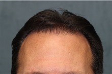 Hair Transplant After Photo by Richard Chaffoo, MD; La Jolla, CA - Case 35354