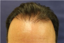 Hair Transplant Before Photo by Richard Chaffoo, MD; La Jolla, CA - Case 35354