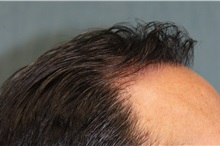 Hair Transplant After Photo by Richard Chaffoo, MD; La Jolla, CA - Case 35354