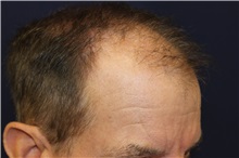 Hair Transplant Before Photo by Richard Chaffoo, MD; La Jolla, CA - Case 35355