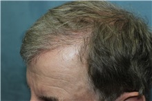 Hair Transplant After Photo by Richard Chaffoo, MD; La Jolla, CA - Case 35355