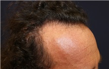 Hair Transplant Before Photo by Richard Chaffoo, MD; La Jolla, CA - Case 35356
