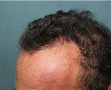Hair Transplant After Photo by Richard Chaffoo, MD; La Jolla, CA - Case 35356