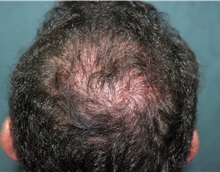 Hair Transplant After Photo by Richard Chaffoo, MD; La Jolla, CA - Case 35356