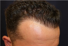 Hair Transplant After Photo by Richard Chaffoo, MD; La Jolla, CA - Case 35358