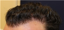 Hair Transplant After Photo by Richard Chaffoo, MD; La Jolla, CA - Case 35358