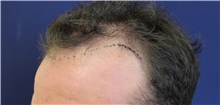 Hair Transplant Before Photo by Richard Chaffoo, MD; La Jolla, CA - Case 35358
