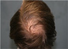 Hair Transplant Before Photo by Richard Chaffoo, MD; La Jolla, CA - Case 44740