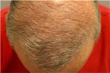Hair Transplant After Photo by Richard Chaffoo, MD; La Jolla, CA - Case 44741