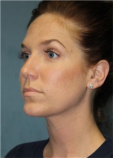 Rhinoplasty After Photo by Richard Chaffoo, MD; La Jolla, CA - Case 44743
