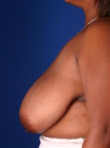 Breast Reduction Before Photo by Robert Centeno, MD; Columbus, OH - Case 25906