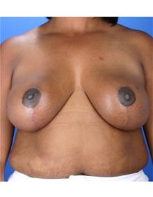 Breast Reduction After Photo by Robert Centeno, MD; Columbus, OH - Case 25906