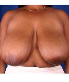 Breast Reduction Before Photo by Robert Centeno, MD; Columbus, OH - Case 25906