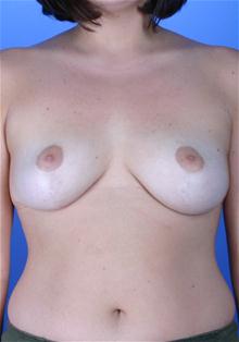 Breast Reduction After Photo by Robert Centeno, MD; Columbus, OH - Case 25908