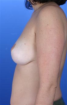 Breast Reduction After Photo by Robert Centeno, MD; Columbus, OH - Case 25908