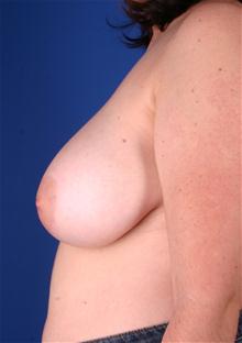 Breast Reduction Before Photo by Robert Centeno, MD; Columbus, OH - Case 25908