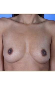 Breast Augmentation Before Photo by Robert Centeno, MD; Columbus, OH - Case 25913