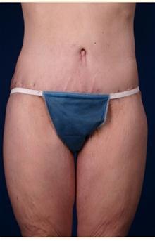 Body Contouring After Photo by Robert Centeno, MD; Columbus, OH - Case 25914