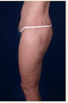 Body Contouring After Photo by Robert Centeno, MD; Columbus, OH - Case 25915