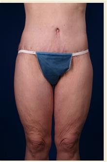 Body Contouring After Photo by Robert Centeno, MD; Columbus, OH - Case 25916