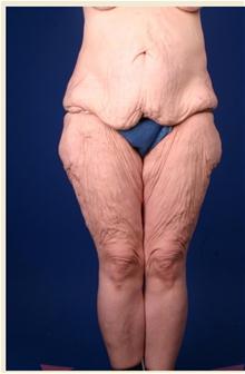 Body Contouring Before Photo by Robert Centeno, MD; Columbus, OH - Case 25916