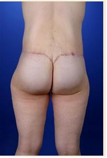 Body Contouring After Photo by Robert Centeno, MD; Columbus, OH - Case 25917