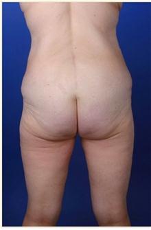 Body Contouring Before Photo by Robert Centeno, MD; Columbus, OH - Case 25917