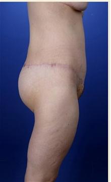 Body Contouring After Photo by Robert Centeno, MD; Columbus, OH - Case 25918