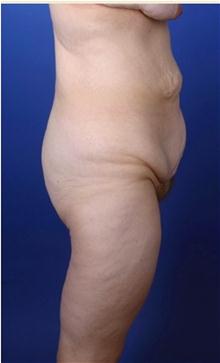 Body Contouring Before Photo by Robert Centeno, MD; Columbus, OH - Case 25918