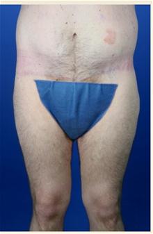 Body Contouring After Photo by Robert Centeno, MD; Columbus, OH - Case 25919