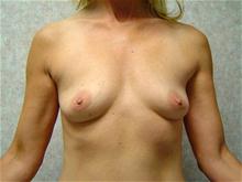 Breast Augmentation Before Photo by Lane Smith, MD; Las Vegas, NV - Case 27036