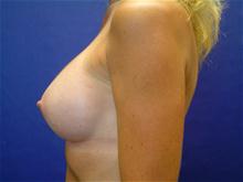Breast Augmentation After Photo by Lane Smith, MD; Las Vegas, NV - Case 27036