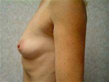 Breast Augmentation Before Photo by Lane Smith, MD; Las Vegas, NV - Case 27036
