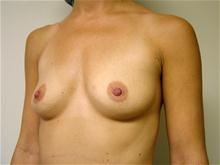 Breast Augmentation Before Photo by Lane Smith, MD; Las Vegas, NV - Case 27037
