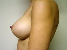 Breast Augmentation After Photo by Lane Smith, MD; Las Vegas, NV - Case 27037