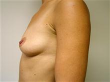 Breast Augmentation Before Photo by Lane Smith, MD; Las Vegas, NV - Case 27037