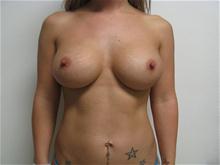 Breast Augmentation After Photo by Lane Smith, MD; Las Vegas, NV - Case 27038