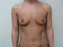 Breast Augmentation Before Photo by Lane Smith, MD; Las Vegas, NV - Case 27038
