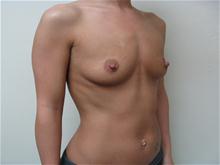 Breast Augmentation Before Photo by Lane Smith, MD; Las Vegas, NV - Case 27038