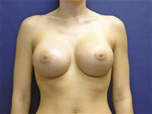 Breast Augmentation After Photo by Lane Smith, MD; Las Vegas, NV - Case 27039