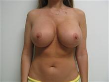 Breast Lift After Photo by Lane Smith, MD; Las Vegas, NV - Case 27040