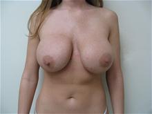 Breast Lift Before Photo by Lane Smith, MD; Las Vegas, NV - Case 27040