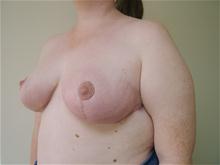 Breast Reduction After Photo by Lane Smith, MD; Las Vegas, NV - Case 27041