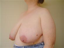Breast Reduction Before Photo by Lane Smith, MD; Las Vegas, NV - Case 27041