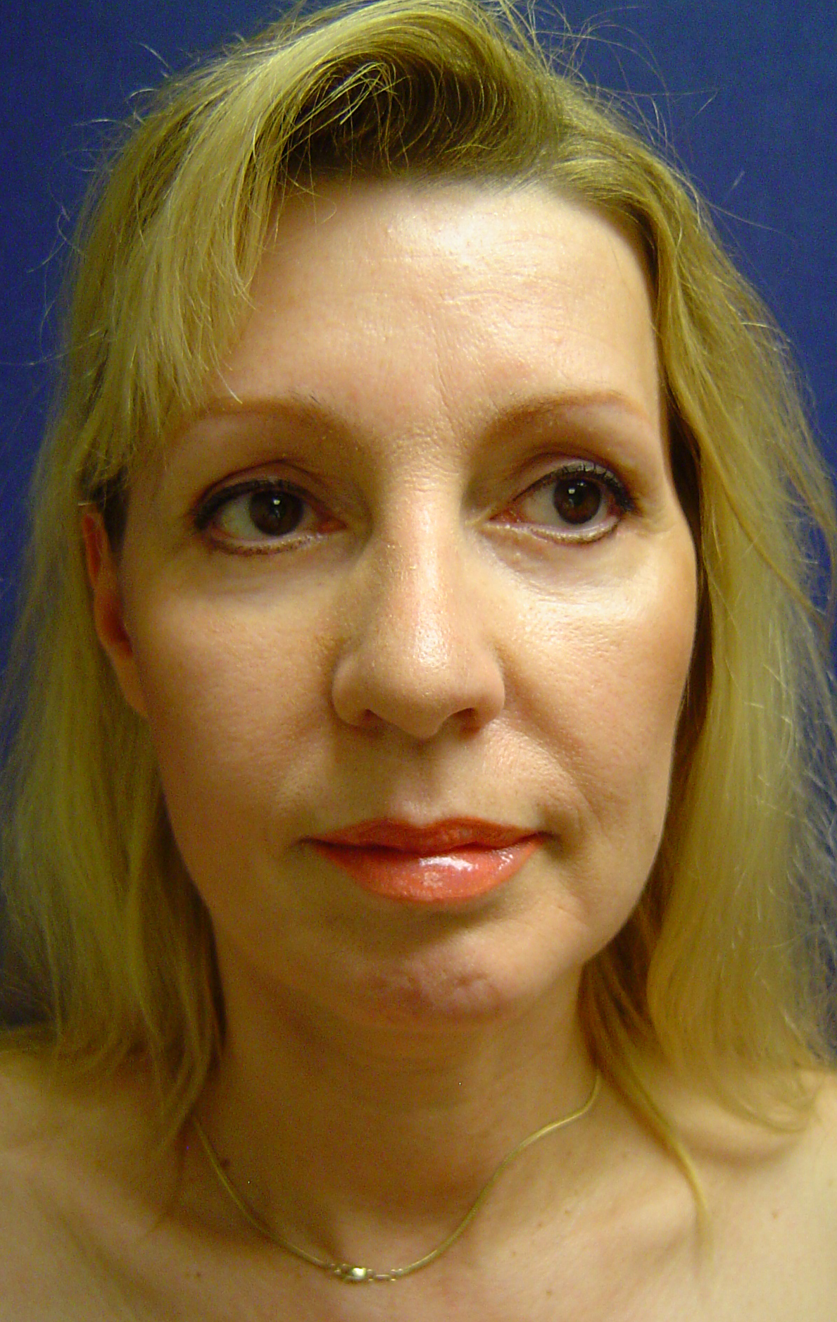 Eyelid Surgery Before and After Photos by Lane Smith, MD