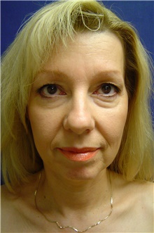 Eyelid Surgery Before Photo by Lane Smith, MD; Las Vegas, NV - Case 27045