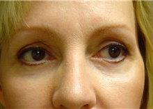 Eyelid Surgery After Photo by Lane Smith, MD; Las Vegas, NV - Case 27045