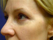 Eyelid Surgery After Photo by Lane Smith, MD; Las Vegas, NV - Case 27046