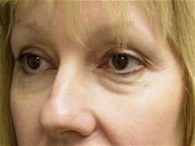 Eyelid Surgery Before Photo by Lane Smith, MD; Las Vegas, NV - Case 27046