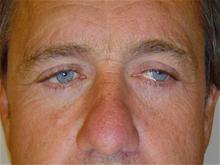 Eyelid Surgery After Photo by Lane Smith, MD; Las Vegas, NV - Case 27047
